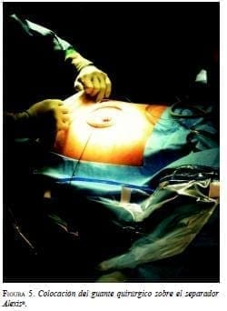 Colocación del Guante Quirúrgico Colocación del Guante Quirúrgico