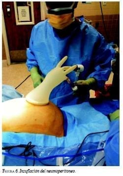 Insuflación del Neumoperitoneo Insuflación del Neumoperitoneo