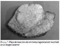 Pieza de Resección de Carcinoma