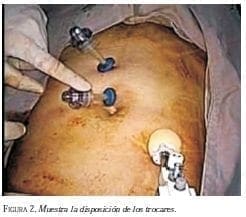 Muestra la Disposición de los Trocares