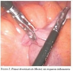 Primer Diverticulo de Meckel