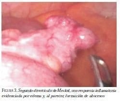 Segundo Diverticulo de Meckel