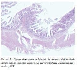 Primer Diverticulo de Meckel