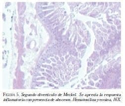Segundo Diverticulo de Meckel