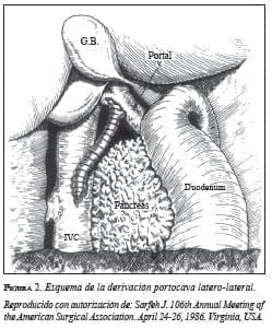 Esquema de la Derivación Portacava