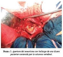 Apertura del Aneurisma con Úlcera