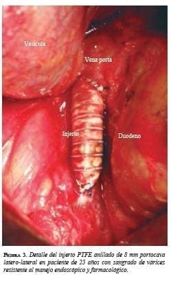 Detalle del Injerto PTFE