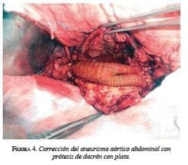 Corrección del Aneurisma Aórtico