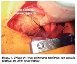 Origen en venas pulmonares