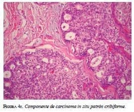 Componente de Carcinoma papilar Componente de Carcinoma papilar