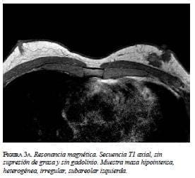 Resonancia magnética secuencia axial Resonancia magnética secuencia axial