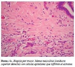 Biopsia por trucut mama masculina Biopsia por trucut mama masculina