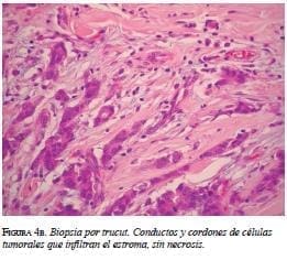 Biopsia por trucut células tumorales Biopsia por trucut células tumorales
