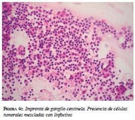 Impronta de ganglio centinela Impronta de ganglio centinela