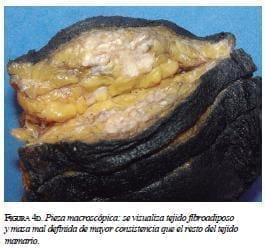 Pieza macroscópica Pieza macroscópica