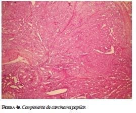Componente de Carcinoma Componente de Carcinoma