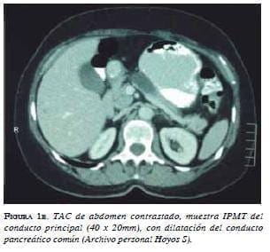 TAC de Abdomen Contrastado