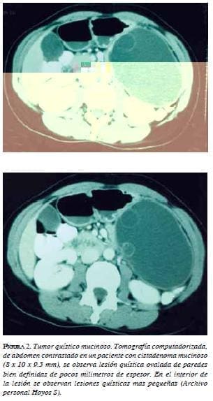 Tumor Quístico Mucinoso Tumor Quístico Mucinoso