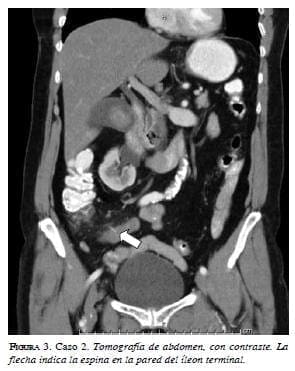 Tomografía de abdomen con contraste