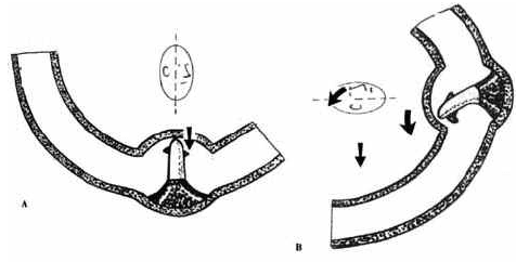Cupulolitiasis Cupulolitiasis