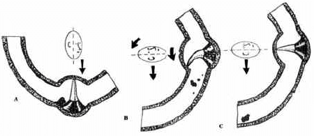 Canalitiasis Canalitiasis
