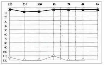 Audiometrías tonales