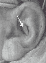 Sitio donante de la cimba concha Sitio donante de la cimba concha