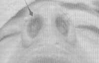 Colocación del injerto Colocación del injerto