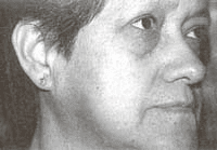 Conjuntivitis y resequedad