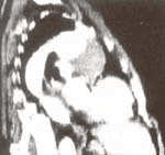 Aneurisma por reconstrucción tomográfica