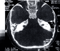 Paladar reconstruido Paladar reconstruido