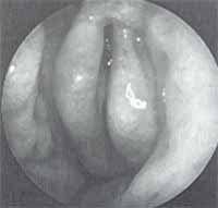 proceso inflamatorio sinusal del lado contrario a la desviación