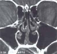 obstrucción nasal a predominio derecho