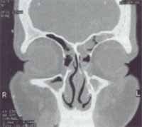 Acceso endoscópico a las cavidades sinusales