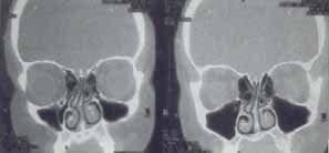 patología obstructiva e inflamatoria sinusal