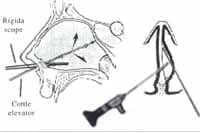 Disección endoscópica de los túneles septales Disección endoscópica de los túneles septales