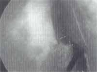 Disección endoscópica del submucopericondrio subyacente Disección endoscópica del submucopericondrio subyacente