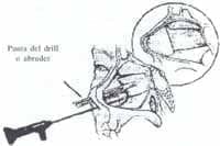 Incisión del túnel submucopericondrial Incisión del túnel submucopericondrial