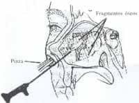 Extracción de fragmentos óseos excedentarios Extracción de fragmentos óseos excedentarios