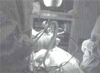 Incisión de hemitransfixión y el túnel submucopericondrial Incisión de hemitransfixión y el túnel submucopericondrial