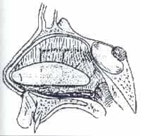 Vista sagital del splint septal colocado Vista sagital del splint septal colocado