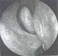 desviación septal obstructiva con cresta, espolón y sinequia