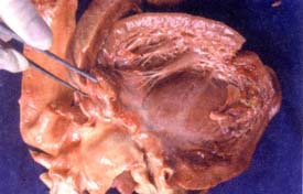 Aspecto macroscópico de las cavidades izquierdas del corazón con trombos murales