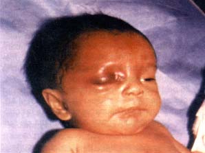 Eritema perineal
