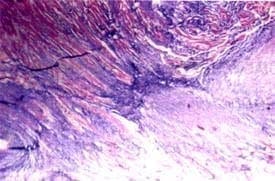 Microfotografía el miocardio. Coloración de tricrómico que evidencia zonas fibrosas (azules)