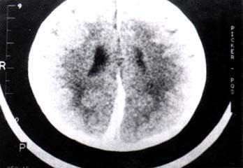 Parasagital frontoparieto-occipital izquierdo Parasagital frontoparieto-occipital izquierdo