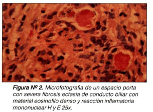 Fibrosis estasia severa