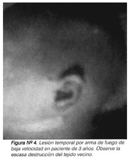 Lesión temporal por arma Lesión temporal por arma