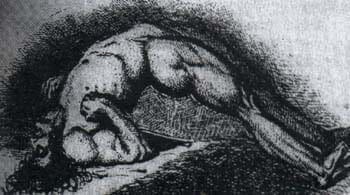 paciente con tétanos en la Batalla de Coruña entre ingleses y franceses. paciente con tétanos en la Batalla de Coruña entre ingleses y franceses.