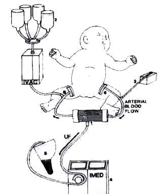 Esquema de CAVH en pacientes